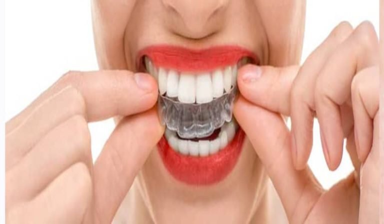 Cómo limpiar tu férula dental