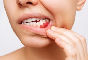 Diagnóstico del fibroma bucal