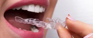 limpieza de la férula dental