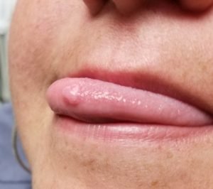 Tratamiento para el fibroma bucal