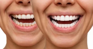cuánto tiempo duran las carillas dentales