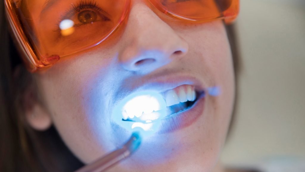 métodos de blanqueamiento dental