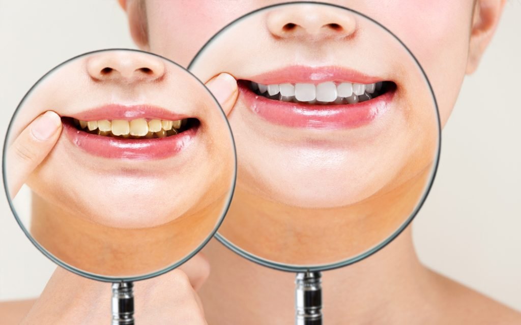 tratamientos de blanqueamiento dental