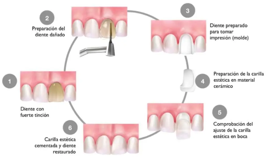 colocacion-de-las-carillas-dentales