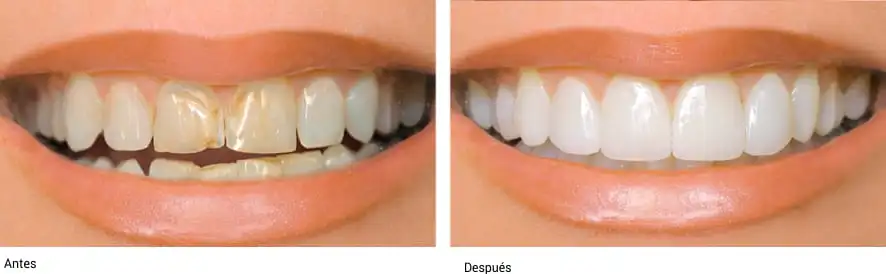 cuidado-de-las-carillas-dentales
