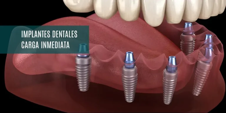 Implantes de carga inmediata