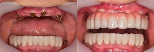 Implantes de carga inmeidata ventajas y desventajas
