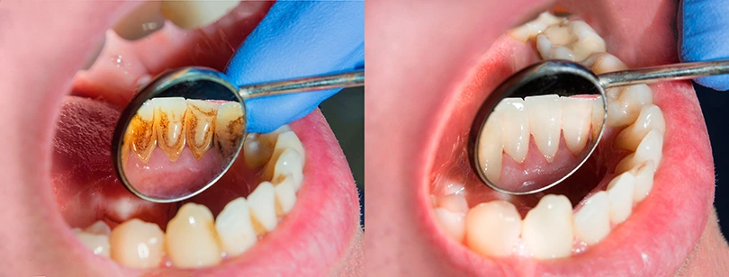 Indicios de mala higiene dental
