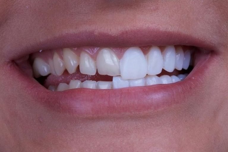 qué-son-las-carillas-dentales