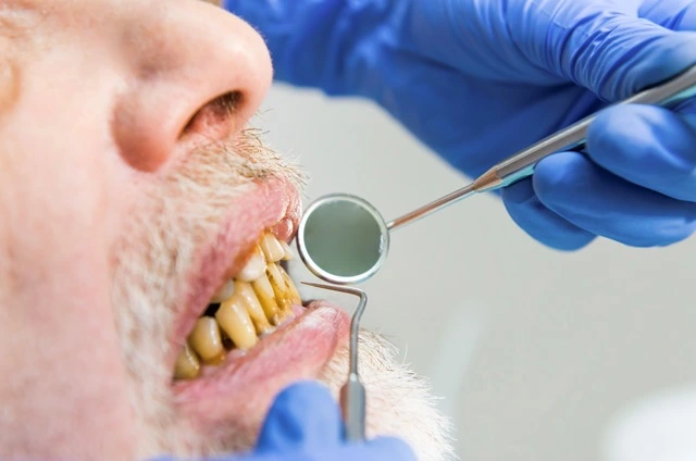 Señales de mala higiene dental