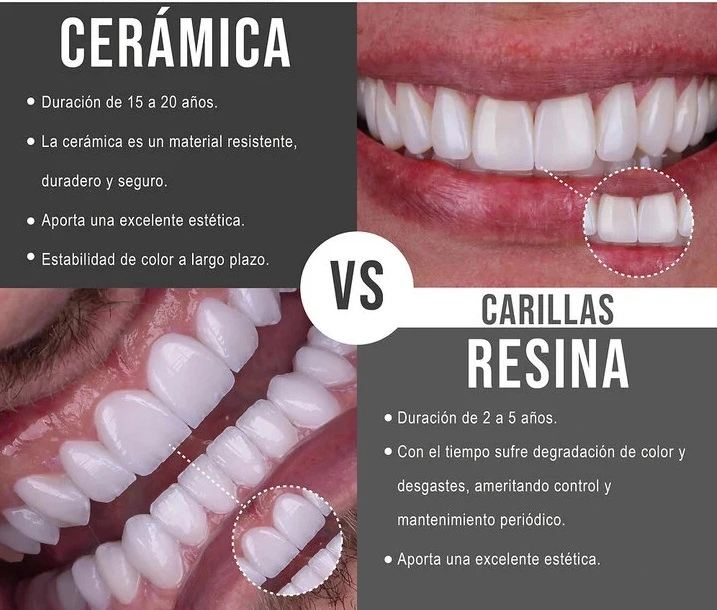 tipos-de-carillas-dentales