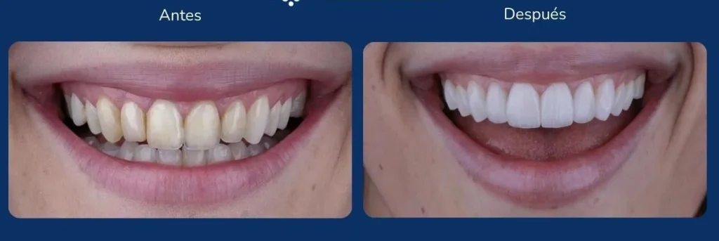 ventajas-de-las-carillas-dentales