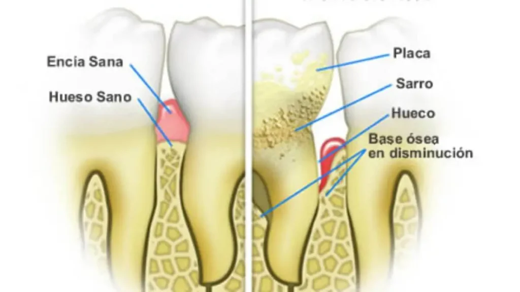 Causas de la pérdida de hueso dental
