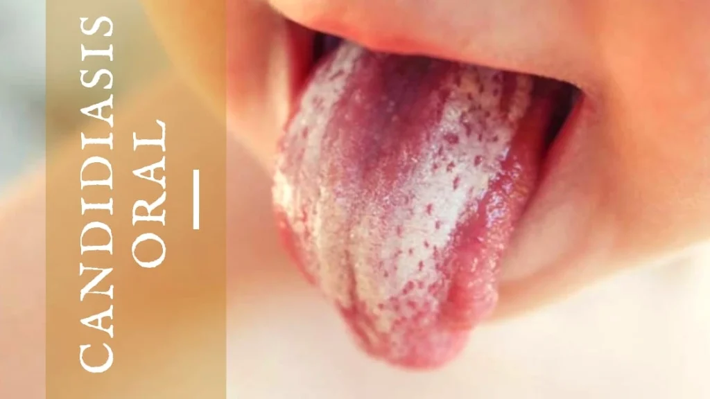 Cómo detectar muguet oral en bebés y adultos