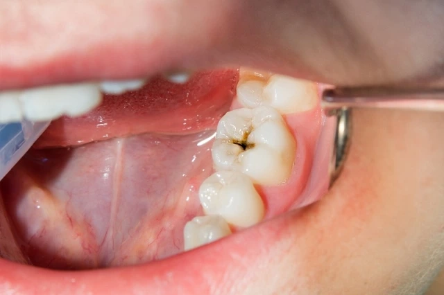 Cómo se si tengo una caries