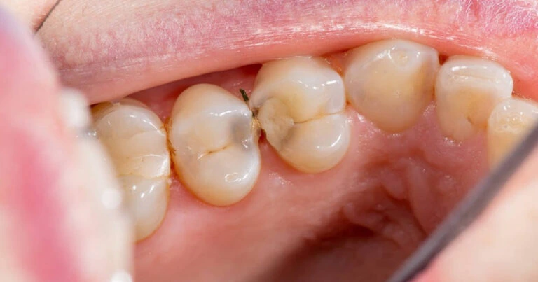 Cómo saber si tengo una caries en una muela