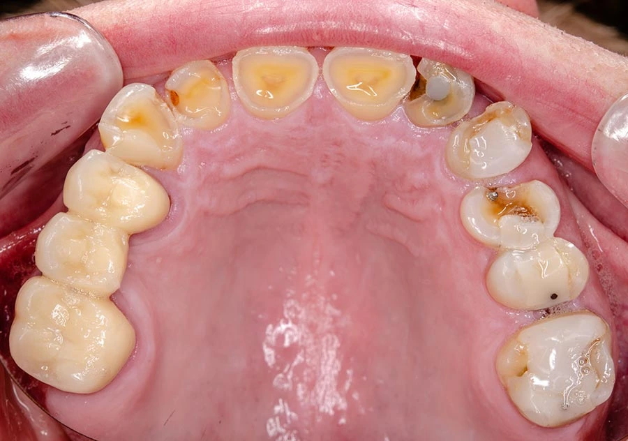 Consecuencias del desgaste dental