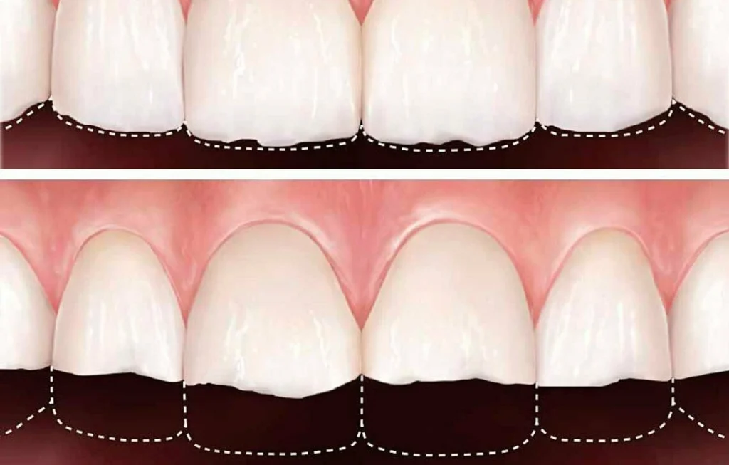 Dientes desgatados por bruxismo