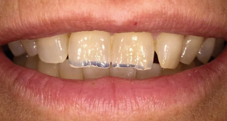 Dientes desgastados solución