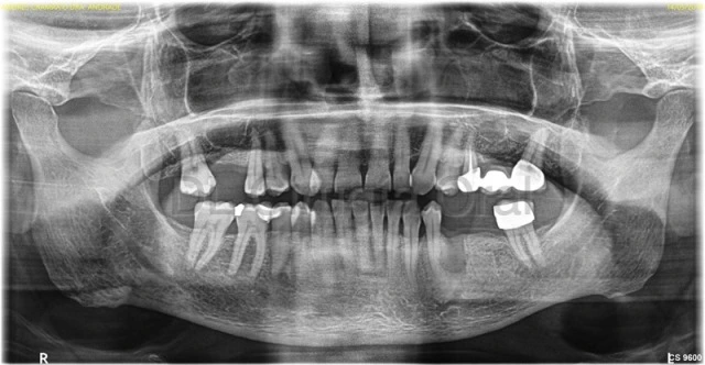 Es seguro colocarse implantes dentales con poco hueso