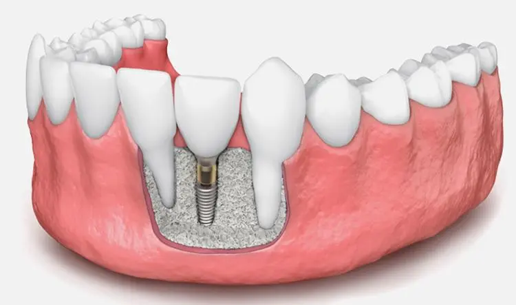 Implantes dentales con poco hueso