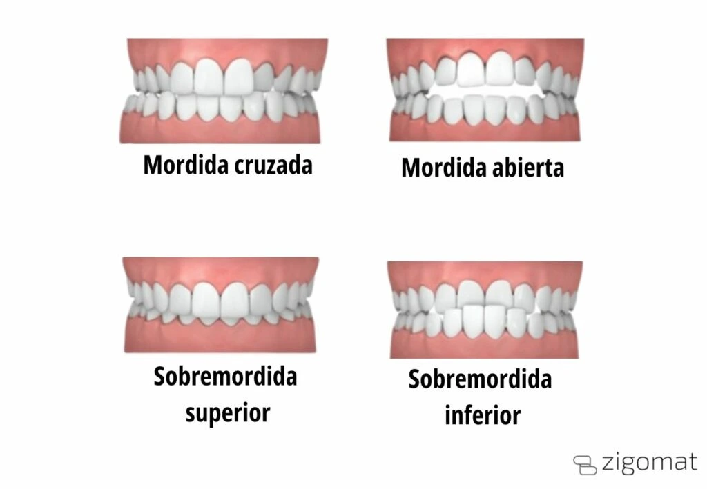 Mordida cruzada tipos