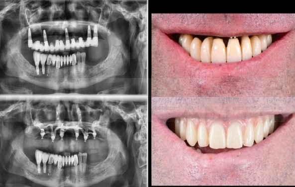 Opciones de implantes dentales con poco hueso