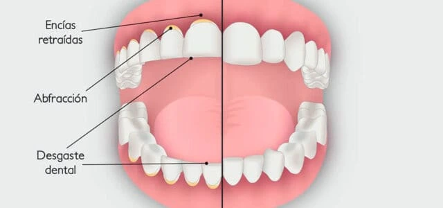 Por qué se desgastan los dientes