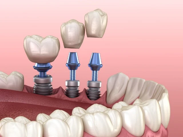 Precios de los implantes dentales con poco hueso