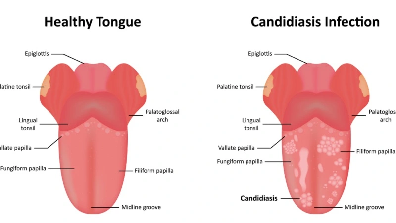 Síntomas del muguet oral