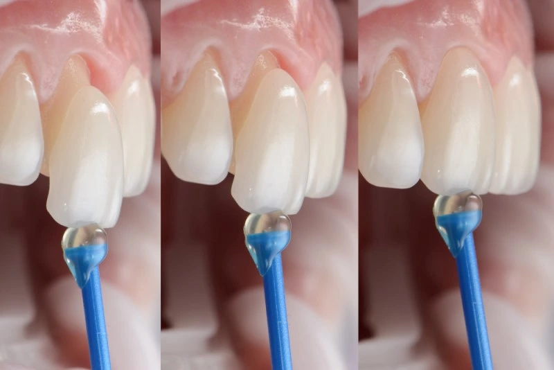 Solución para dientes desgastados