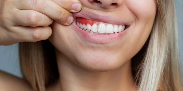 Tratamiento para las encías retraídas