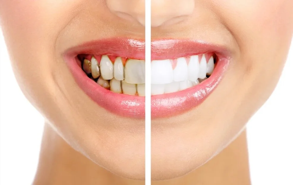 Cómo prevenir manchas en los dientes