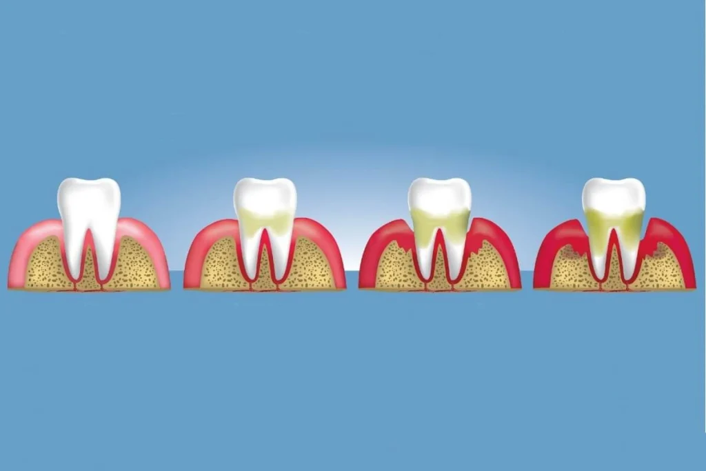 Cómo saber si tengo piorrea dental