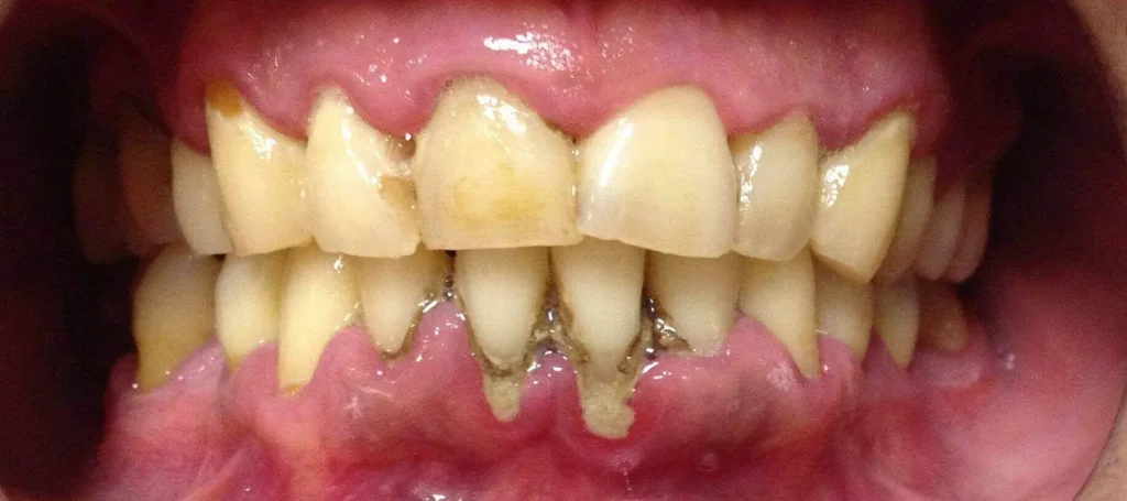 Cómo se cura la piorrea dental