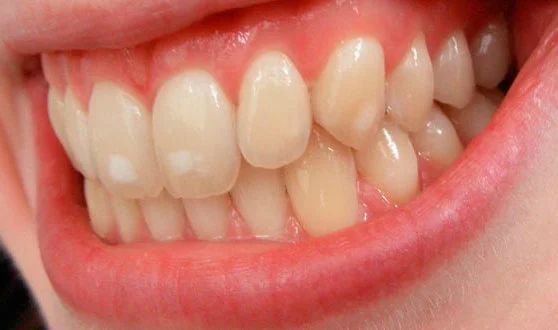 Manchas blancas en los dientes