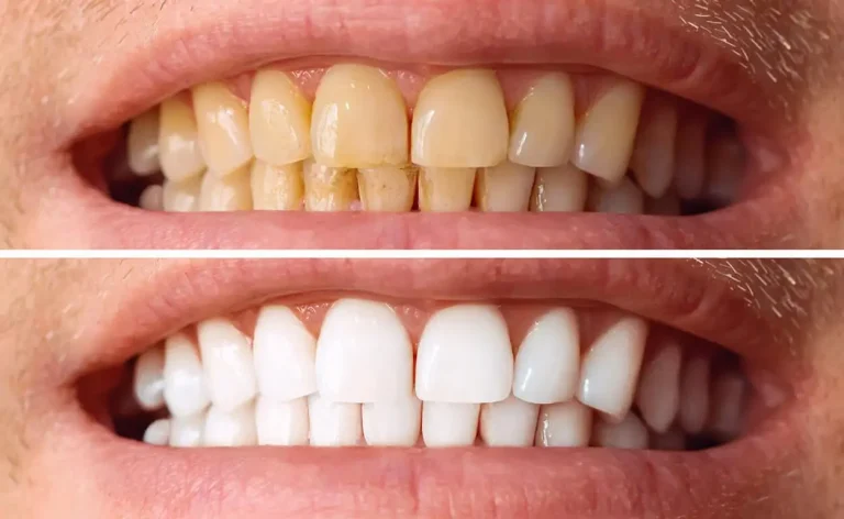 Manchas en los dientes