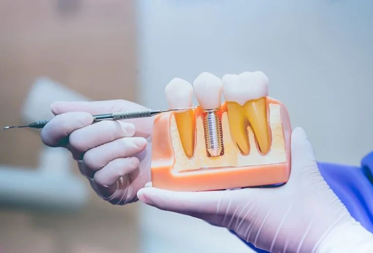 Qué pasa si se mueve un implante dental