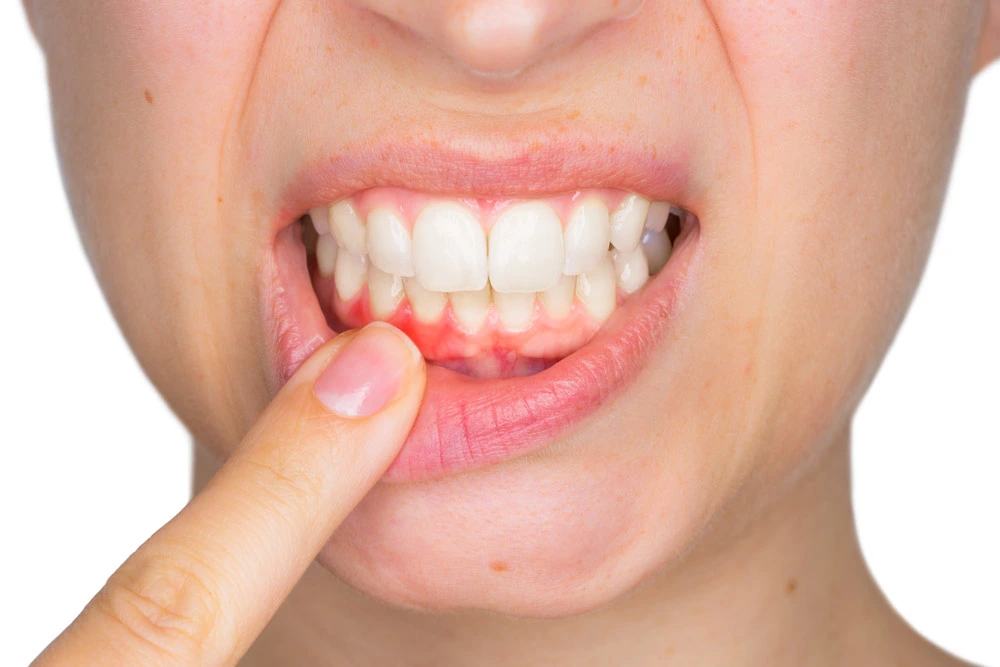 Síntomas de piorrea dental