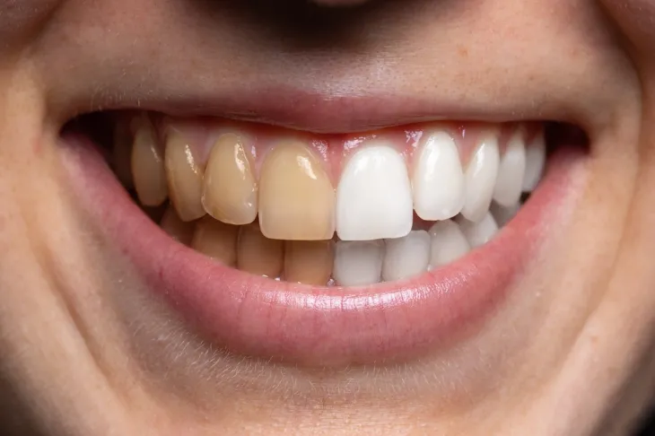 Tipos de manchas en los dientes
