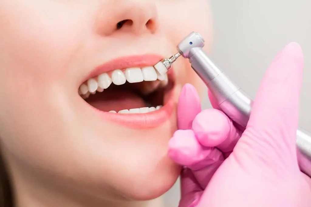 Cómo se hace una limpieza dental regular