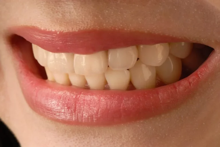 Desgaste del esmalte dental