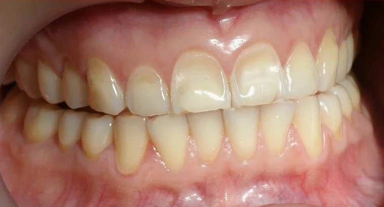 Por qué se desgasta el esmalte dental