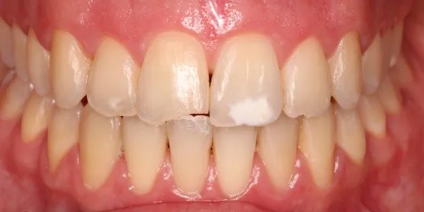 Qué pasa cuando se desgasta el esmalte de los dientes