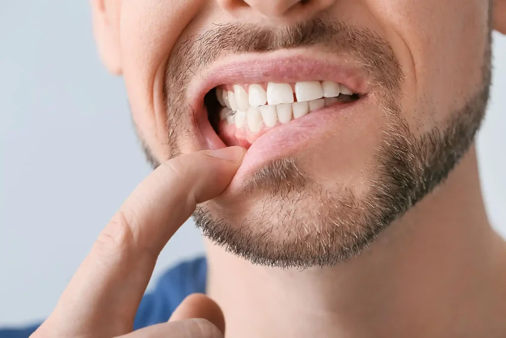 Tratamientos para los puntos blancos en las encías